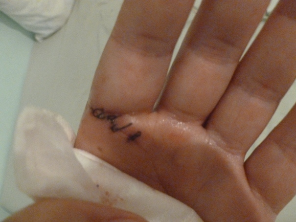 stitched-up-hand.jpg